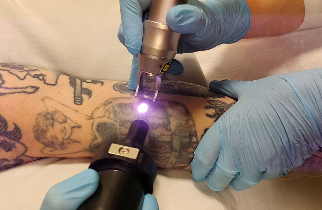 tatoveringsfjernelse-i-viborg